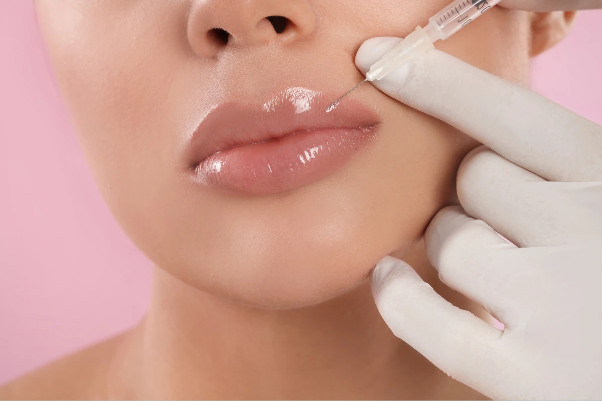 Why Choose Lip Fillers?