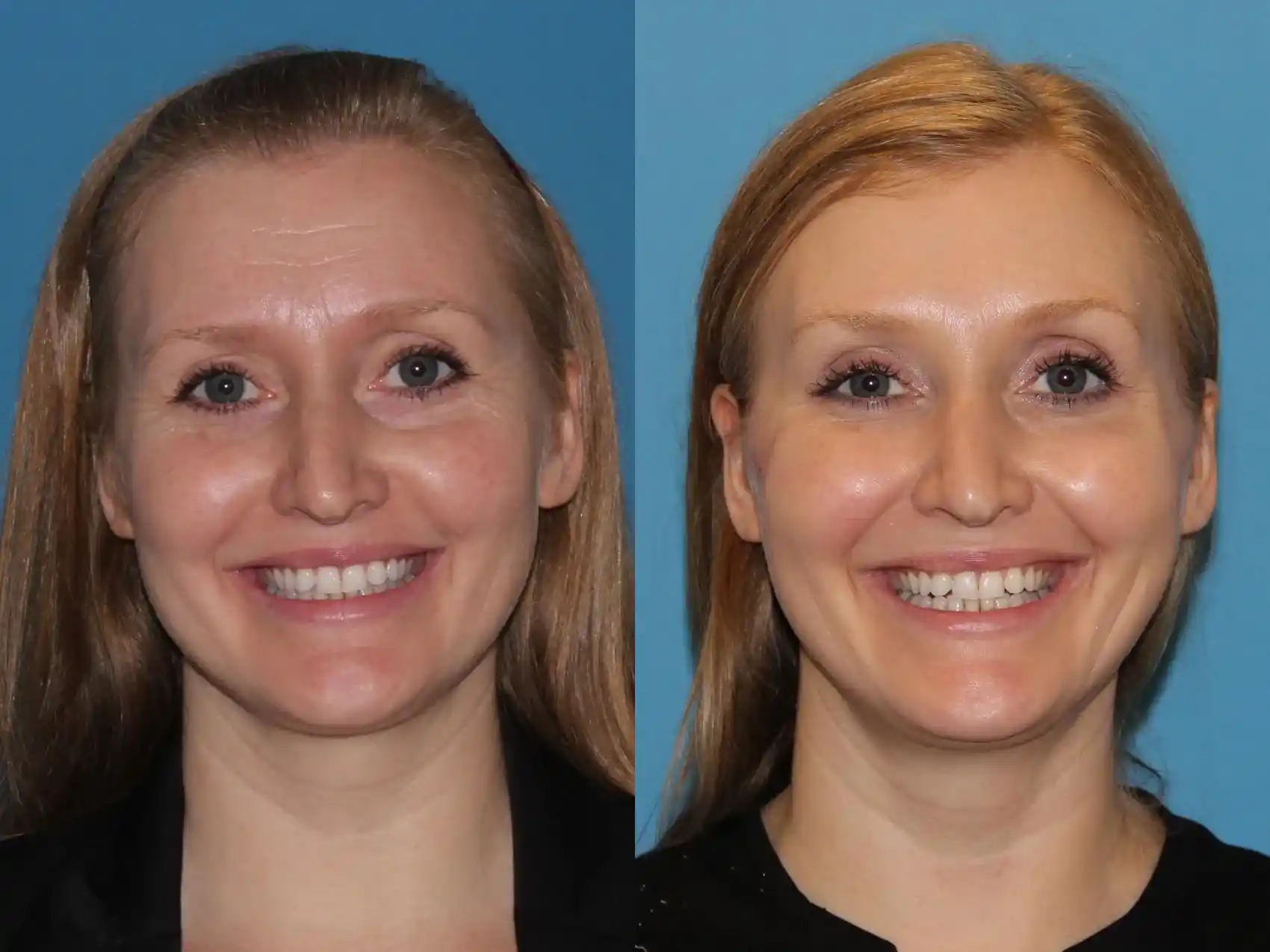 Botox Treatment: Before and After